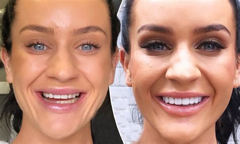 Celebrities With Veneers Before And After