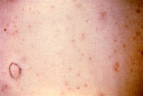 scabies skin rash pictures - pictures, photos