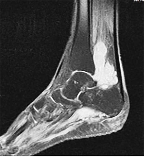 Primary Giant Synovial Sarcoma Of The Right Ankle In A Woman Living