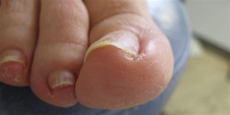 Ingrown Toenails Diagnosis And What You Can Do Baron Active