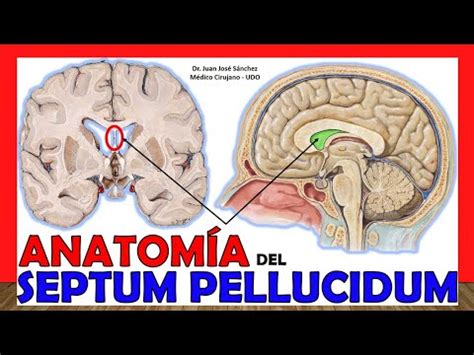 Cavum Septum Pellucidum Diagram