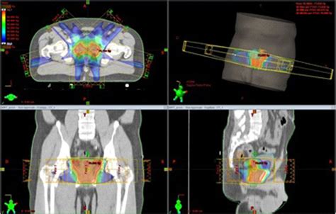 An Example Of Dose Distributions Achieved With Vmat And Fixed Field