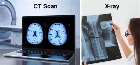 CT Scan vs. X-ray: A Comparative Analysis - Which Imaging Technique is ...