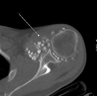 Synovial Osteochondromatosis Of Shoulder Sumer S Radiology Blog