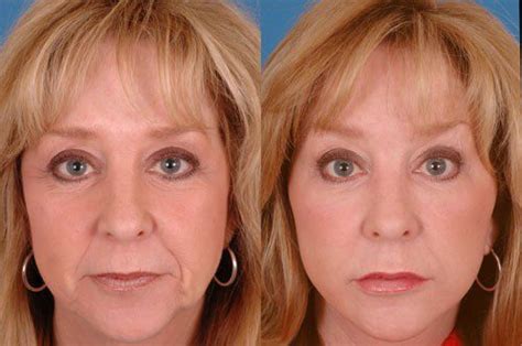 Revision Facelift Before And After Photos Dr Bassichis