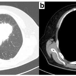 Preoperative Chest Computed Tomography Ct Scan A Chest Ct Scan