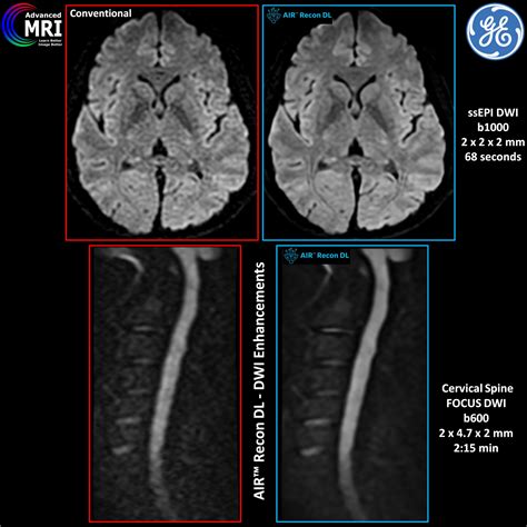 Advanced Mri On Twitter Dwi With Air Recon Dl Less Noise Less