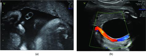 Single Umbilical Artery A 2D Imaging And B Color Doppler Imaging