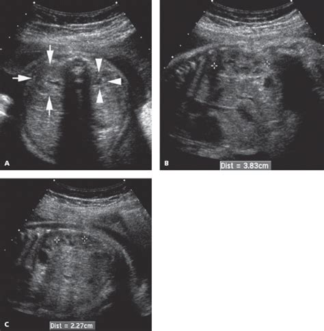 Genitourinary Tract Obgyn Key