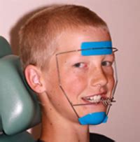 headgear braces for adults - Jacks Blog