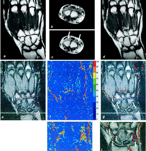 Magnetic Resonance Imaging Of Wrist And Finger Joints In Healthy Subjects Occasionally Shows