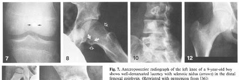 bone lesion | Semantic Scholar