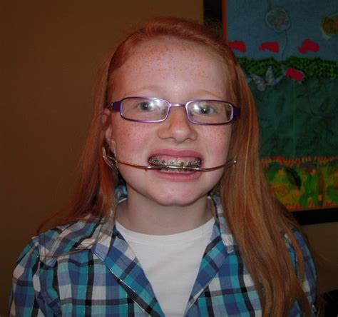 Braces Girls Brace Face Headgear Redheads Future Beautiful Low Pins Quick