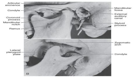 Solution Temporo Mandibular Joint Anatomy Studypool