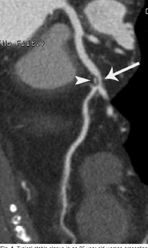 Figure 1 From Current Concepts Of Vulnerable Plaque On Coronary CT