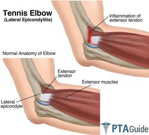 Tennis Elbow And Exercises For Therapy The Complete Overview And Pdf Handout