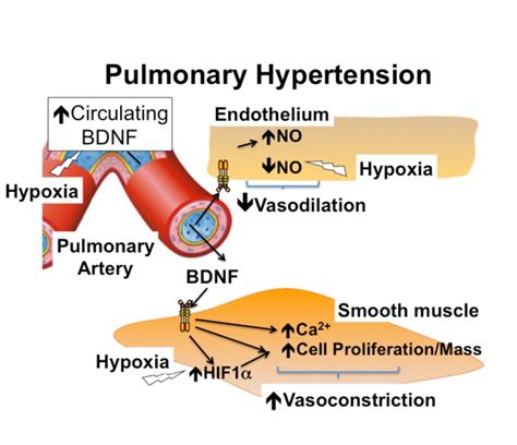 Pulmonary Hypertension List Of High Impact Articles Ppts Journals