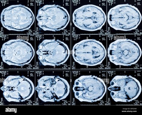 MRI Head Scan Stock Photo - Alamy