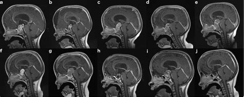 Craniopharyngioma And Pituitary Adenoma