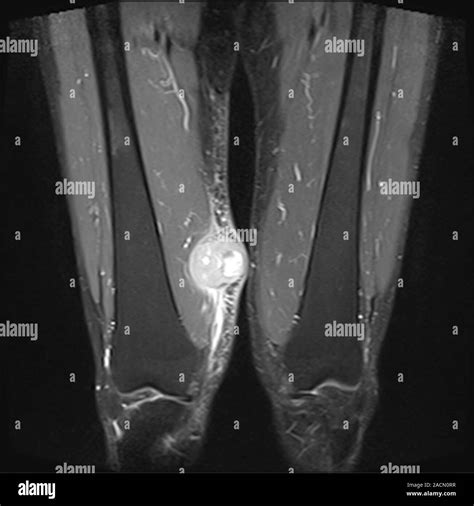 Irm Imágenes Por Resonancia Magnética De Un Tumor Maligno Sarcoma En El Muslo Derecho De Un