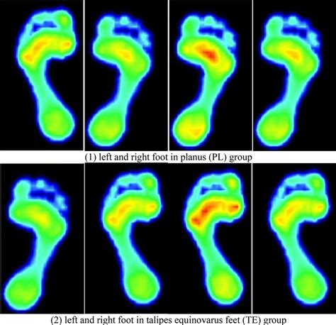 Typical Images From Groups Of Planus Pl And Talipes Equinovarus Feet Te Download