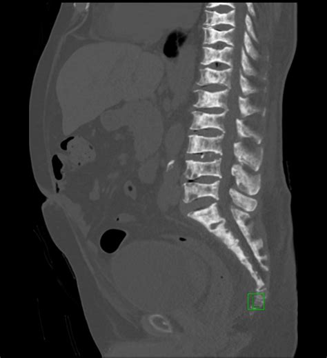 Sickle Cell Disease Abdominal Manifestations Image Radiopaedia Org