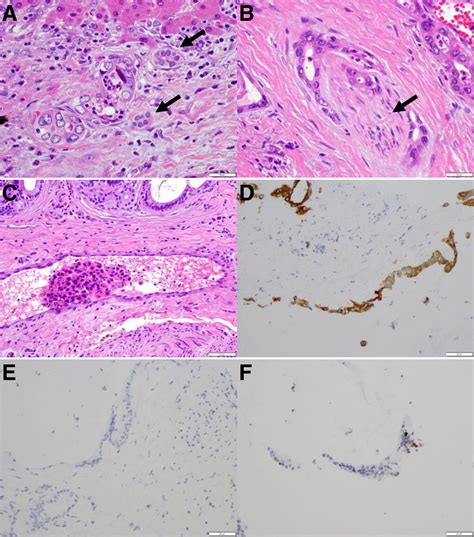 Primary Liver Cancers—part 1 Histopathology Differential Diagnoses And Risk Stratification