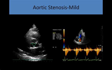 Echocardiogram Aortic Stenosis