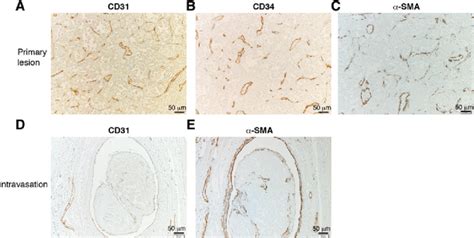 Immunostaining Of Vascular Markers In Human ASPS A C Primary Tumor