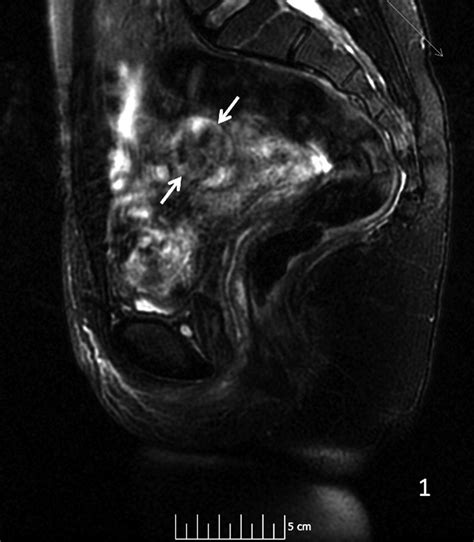 Diagnosis And Management Of An Adenomatoid Uterine Tumor Ultrasound