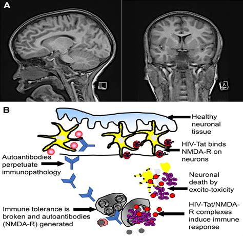 Anti Nmda Receptor Encephalitis In An Adolescent With Hiv In The Pediatric Infectious