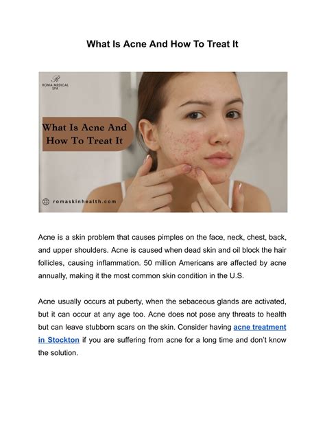 Ppt What Is Acne And How To Treat It Powerpoint Presentation Free Download Id 12113953