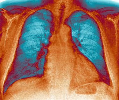 Rapid Iloprost Inhalation Improves Pulmonary Vascular Resistance in PAH ...