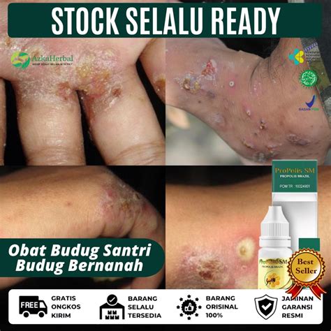 Jual Obat Budug Di Kaki Budug Bernanah Budug Santri Obat Scabies