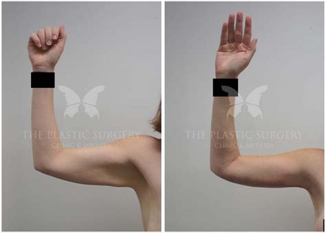 Arm Lift Gallery Before And Afters Dr Chaithan Reddy