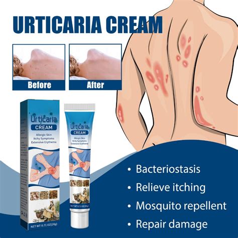 Herbal Antibacterial Itching Cream Skin Rash Urticaria Treatment Care ...