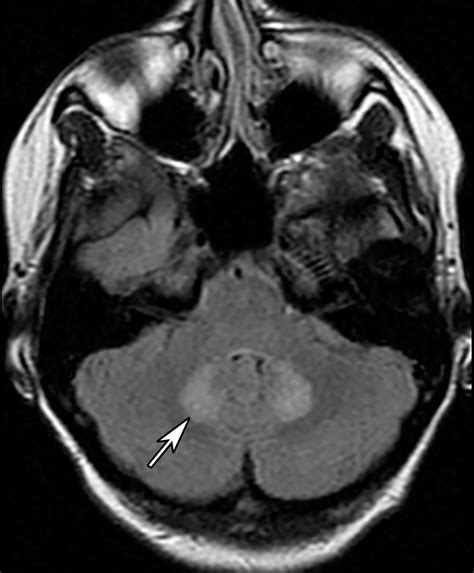 Imaging Patterns of Toxic and Metabolic Brain DisordersRadioGraphics