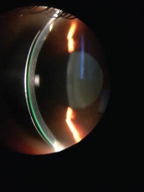 Scleral Lens Benefits For Patients You See Every Day Blanchard