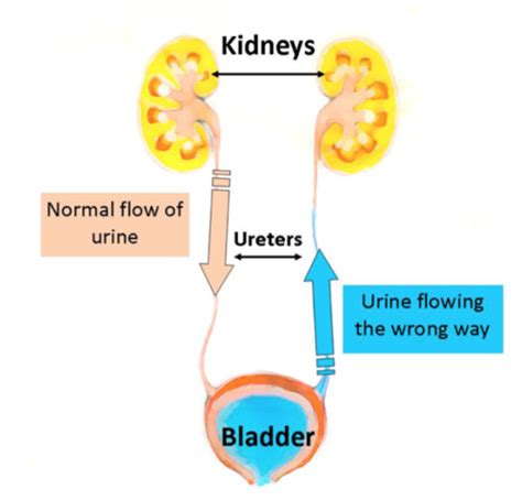 Lower Urinary Tract Symptoms and Obstruction Flashcards | Quizlet