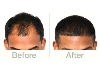 Best Hair Transplant Surgeons In Gwalior Expert Recommendations