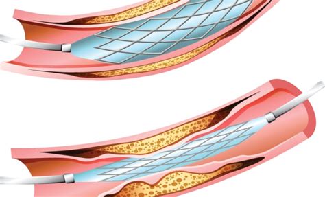 First-Generation Drug-Eluting Stent Outcomes After 10 Years - The Cardiology Advisor