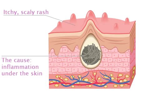 Comizla Psoriasis Cream – Stem Cell Therapy For Psoriasis