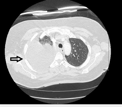 Ct Chest Showing Right Sided Pleural Effusion Download Scientific Diagram