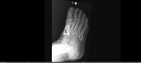 1st Metatarsal Base Fracture — Chicago Foot & Ankle Orthopaedic Surgeons