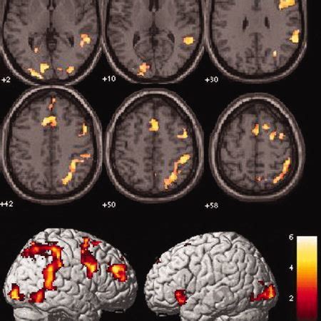 Brain Activation Patterns Across 22q11 2DS TD And DD Groups Color