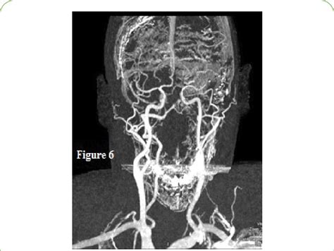 CT angiogram of cerebral vessels. | Download Scientific Diagram