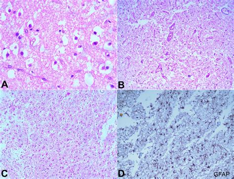 Scielo Brasil Leigh Syndrome In An Infant Autopsy And