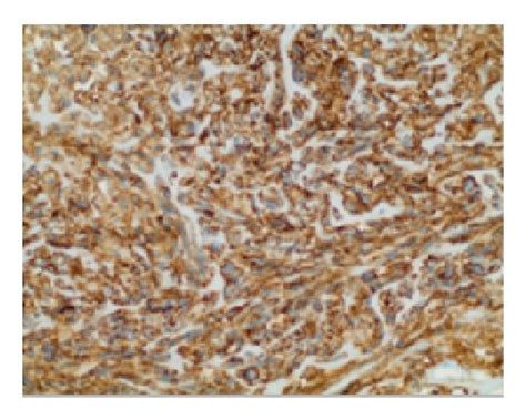 Pathology Shows Spindle Cell Lesion Composed Of Intersecting Fascicles