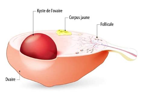 Kyste ovarien quand faut il sinquiéter Information hospitalière