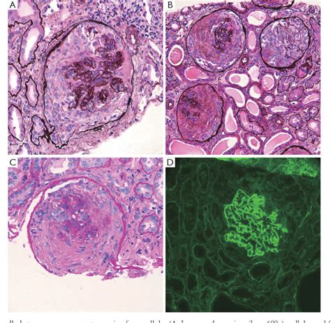 Figure 1 From Seronegative Atypical Anti Glomerular Basement Membrane